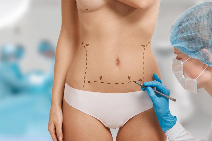 Sculpting Confidence: The Transformative Journey of Tummy Tuck Surgery
